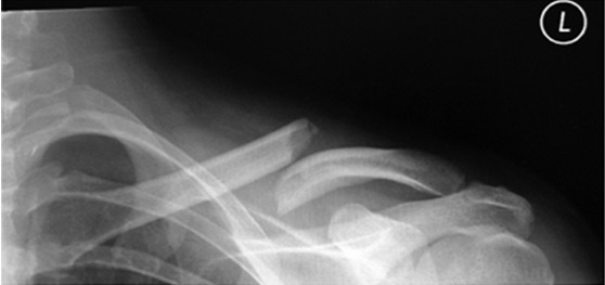 рентгенснимок-перелома-ключицы