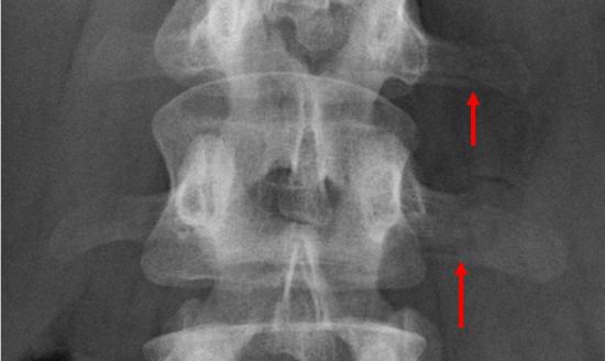 переломы-отростков-рентген