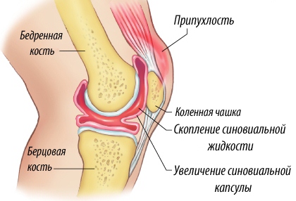 Лечение артроза коленного сустава с синовитом