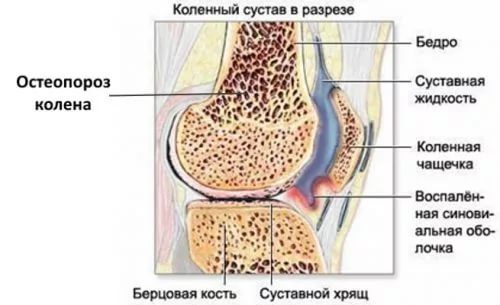 Остеопороз коленного сустава