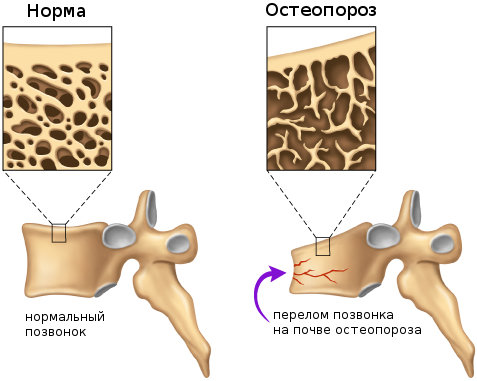 Гимнастика при остеопорозе